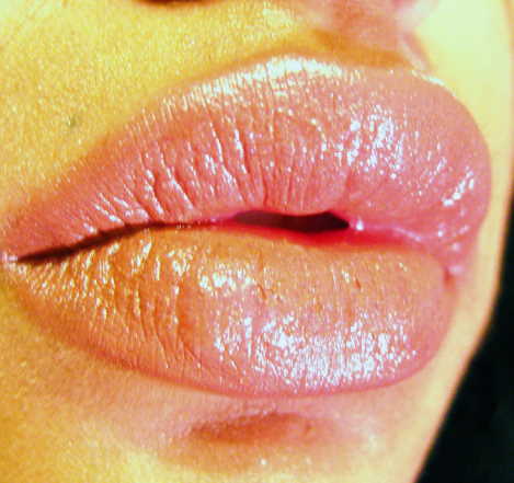 bigger lips